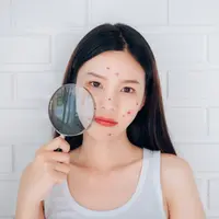 ilustrasi kandungan skincare untuk menyembuhkan jerawat pustula/ Potential Filmmaker/shutterstock