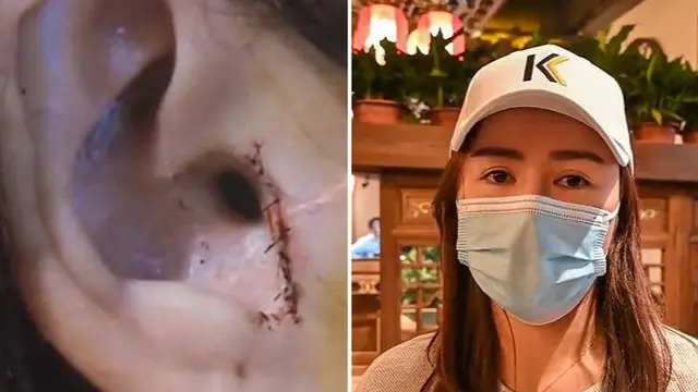 wanita kehilangan tulang rawan telinganya usai operasi hidung