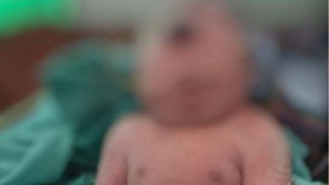 Kasus kelahiran langka bayi bermata satu terjadi di Kabupaten Mandailing Natal, Sumatera Utara. (Reza Efendi/ Liputan6.com)