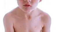 Ilustrasi alergi (iStock)