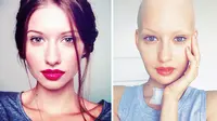 Elizaveta Bulokhova, model cantik yang terkena kanker tulang yang menyerang rahang. (Huffington Post)
