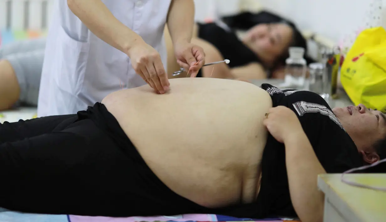 Terapis memberi terapi akupuntur kepada wanita yang kelebihan berat badan atau obesitas di klinik penurun berat badan di Changchun, Jilin, China, Selasa (17/7). (STR/AFP)