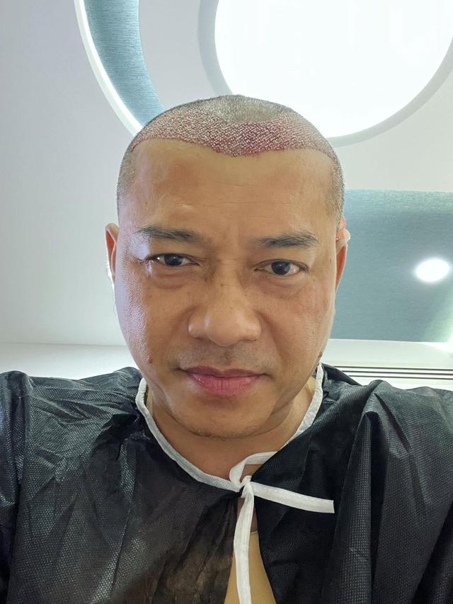 Dikira Raul Lemos, Ini 6 Potret Anang Hermansyah Usai Transplantasi Rambut di Turki