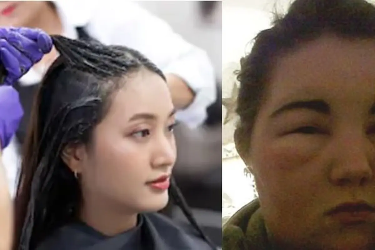 Gara-Gara Warnai Rambut, Wanita Ini Alami Alergi Matahari