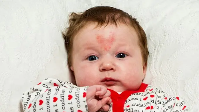 Sambut Valentine, Bayi Imut Punya Tanda Lahir Bentuk Hati, Aw!