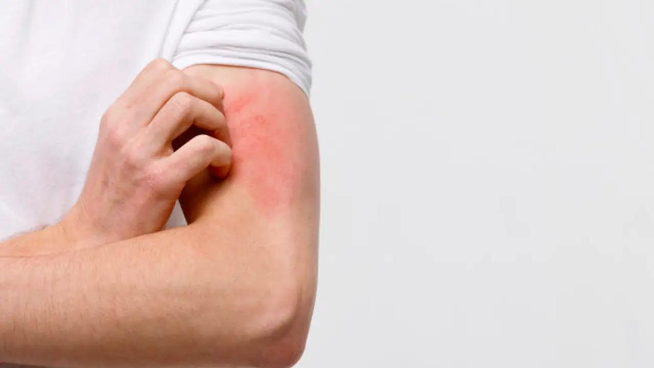 7 Kebiasaan yang Memicu Jamur Kulit, Jangan Anggap Sepele Lagi!