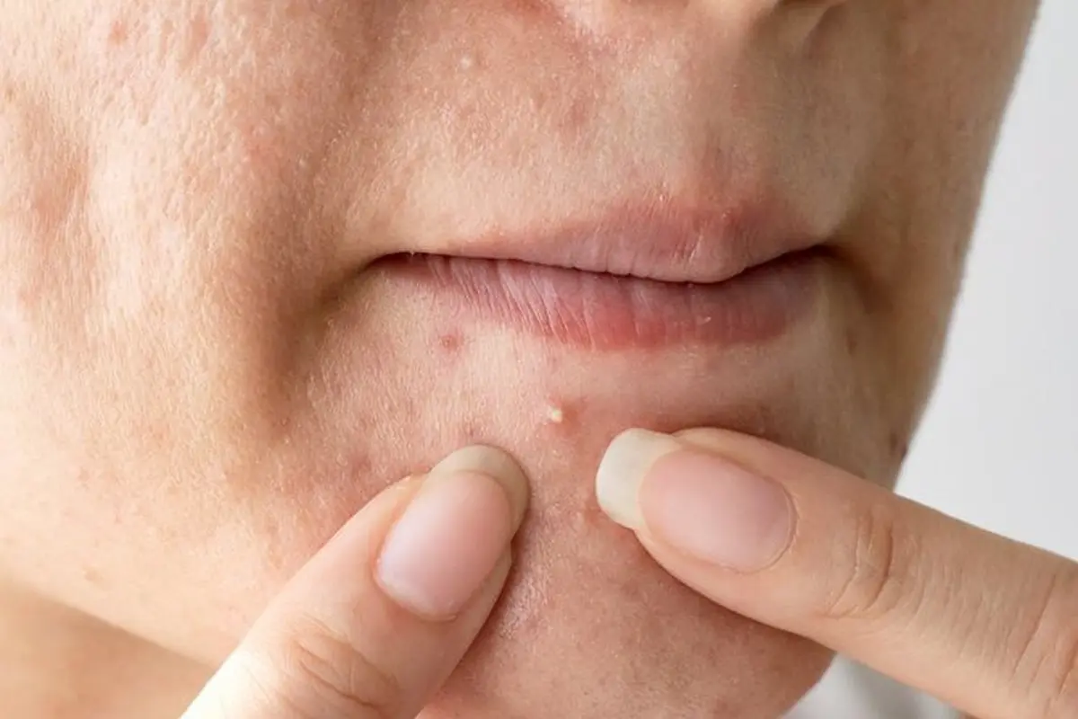 Pencet Jerawat di Dekat Bibir, Pria Ini Hampir Meninggal Dunia