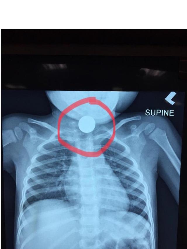 Balita Ini Tersedak Koin Selama 24 Jam, Kisahnya Bikin Miris