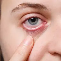 Penyebab dan Cara Mengatasi Bisulan di Kelopak Mata Anak