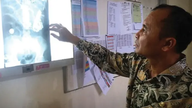 Baterai hingga Garpu, 52 Benda Asing Ditemukan di Perut Pria Asal Jember