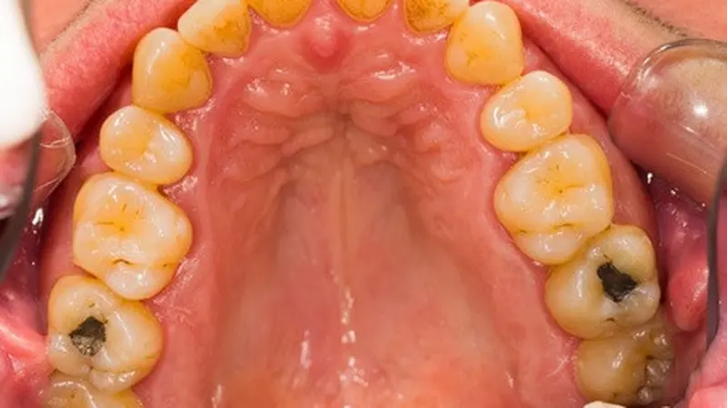 Gigi Berlubang Sebabkan Sinusitis