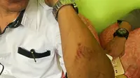 Korban pemukulan oleh siswanya memperlihatkan luka memar di tangan. (Liputan6.com/Istimewa/M Syukur)