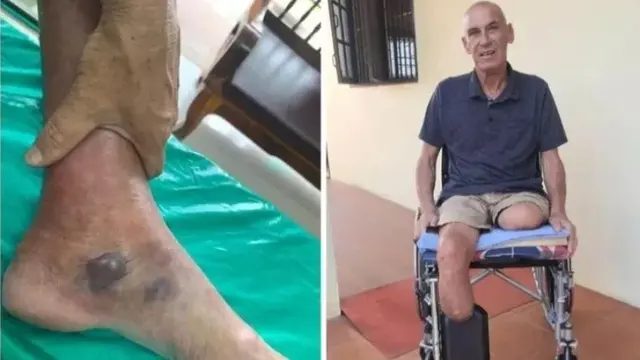 Pria Belanda Kehilangan Kedua Kakinya Akibat Gigitan Nyamuk