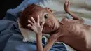 Seorang anak laki-laki penderita gizi buruk berada di tempat tidur rumah sakit di Aslam Health Centre, Hajjah, Yaman (1/11). Malnutrisi, kolera, dan penyakit epidemi lainnya seperti difteri telah menular di daerah tersebut. (AP Photo / Hani Mohammed)