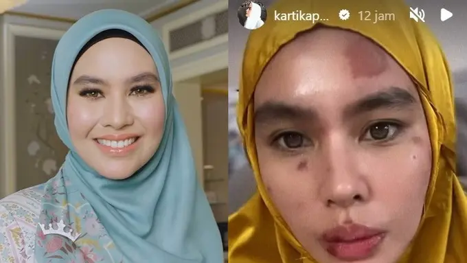 Kartika Putri alami wajah ruam (Instagram/kartikaputriworld)