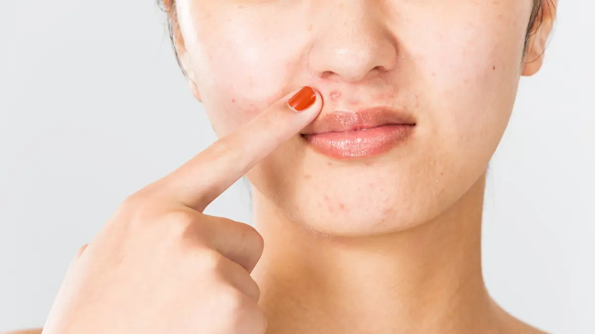 Kenali 6 Penyebab Munculnya Jerawat di Sekitar Mulut - Beauty ...