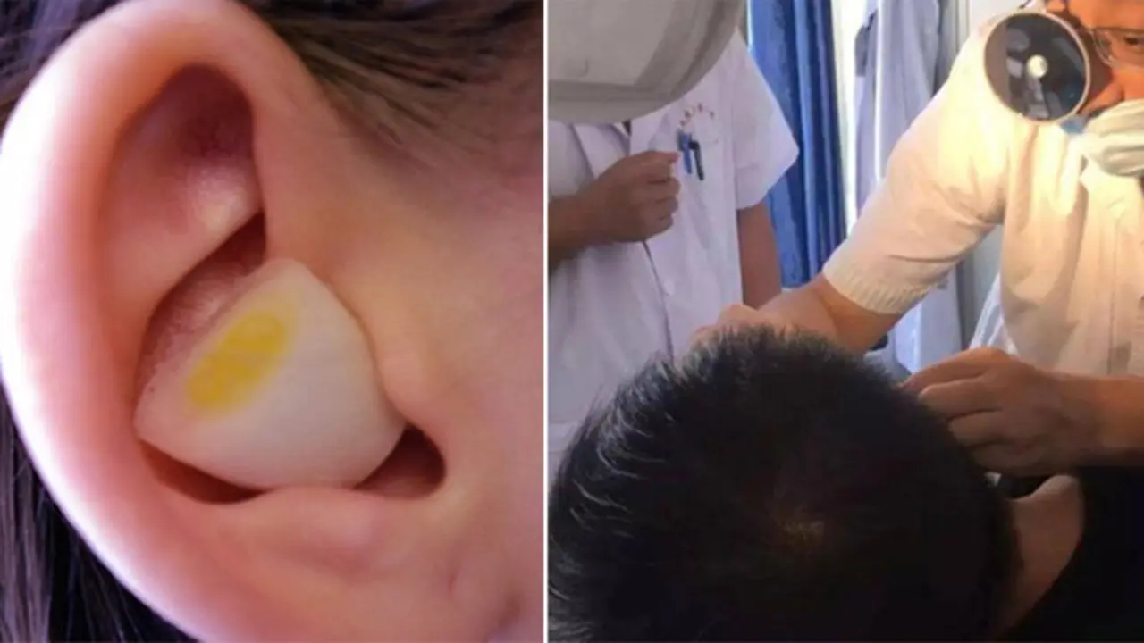 Pakai Bawang Putih ke Telinga Saat Susah Tidur, Pria Ini Alami Nasib Nahas