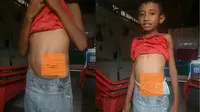 Constantino Soares, bocah 11 tahun di Malaka NTT terlahir tanpa anus. (Liputan6.com/ Ola Keda)