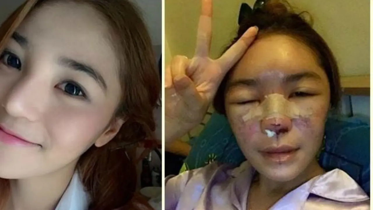 Gara-gara Suntik Silikon, Model ini Berubah Jadi Buruk Rupa
