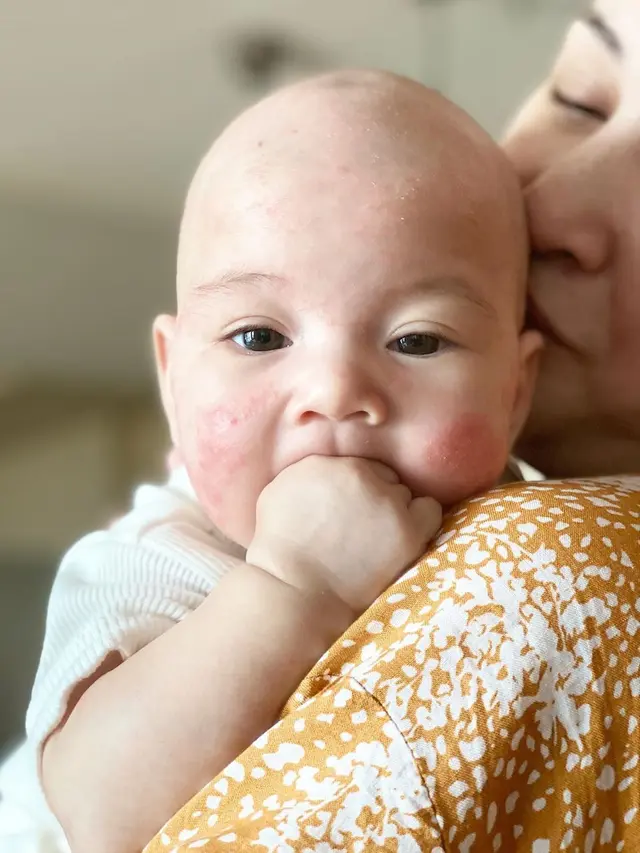 7 Potret Perjuangan Mona Ratuliu Rawat Anak yang Idap Dermatitis Atopik