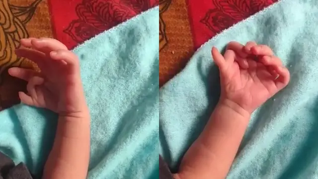 Bayi Perempuan di India Memiliki 26 Jari