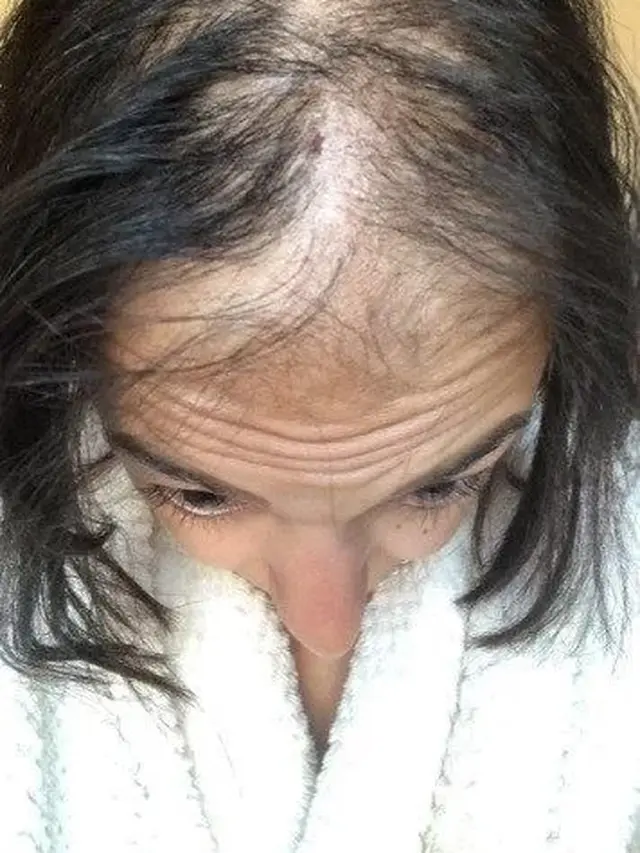 Kisah Rima Theisen, pramugari yang alami kerontokan rambut ekstrem