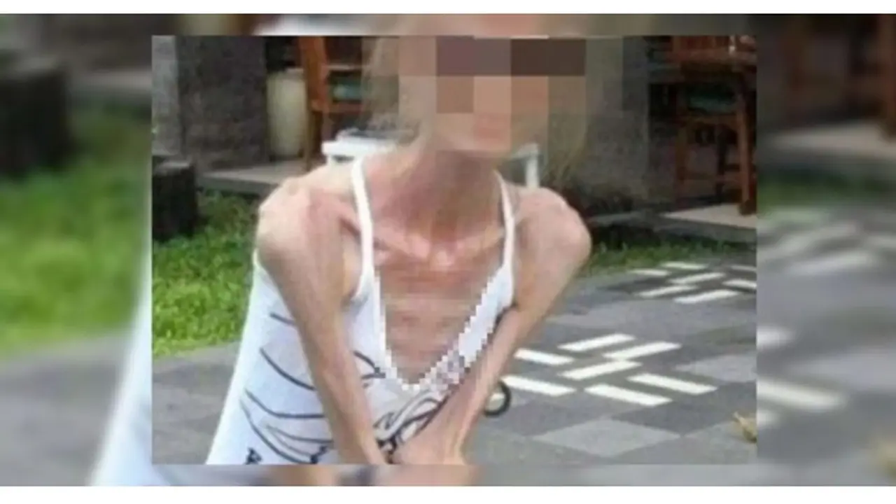 Terobsesi Langsing, Wanita Ini Lakukan Diet Ekstrem hingga Berat Badannya 25 Kg