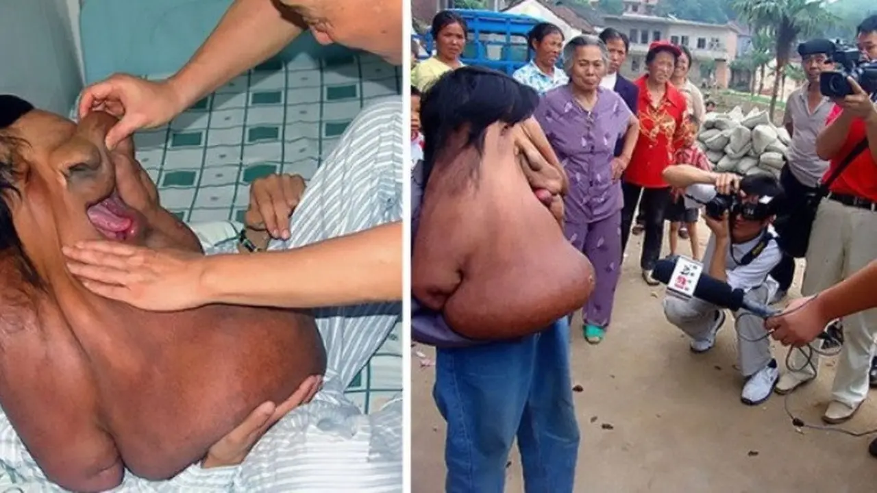 Pria ini idap tumor seberat 15 kg (elitereaders)
