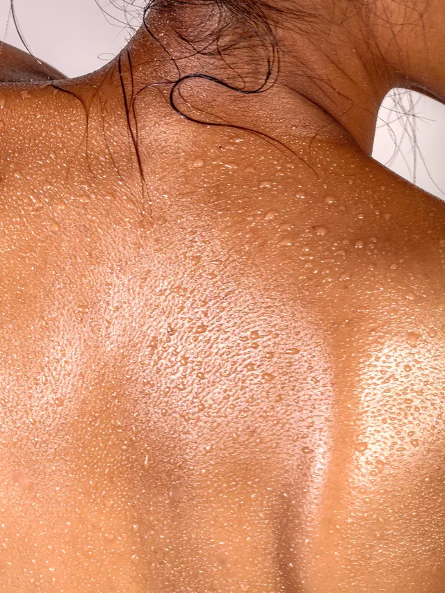 Gejala Keratosis Pilaris