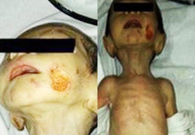 Kondisi bayi malang yang tinggal rangka, serta ada bekas luka gigitan di wajahnya | foto: copyright dailymail.co.uk