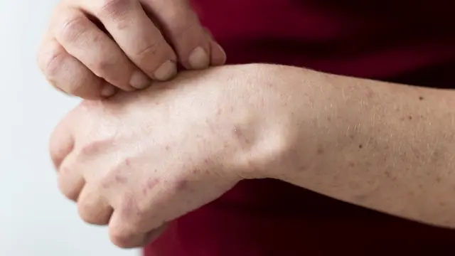 Cara agar Cacar Cepat Kering