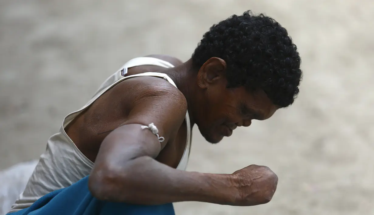 Seorang pria penderita kusta, Ram yang kehilangan kaki dan tangan di Kathmandu (14/7). (AFP Photo/Gopen Rai)