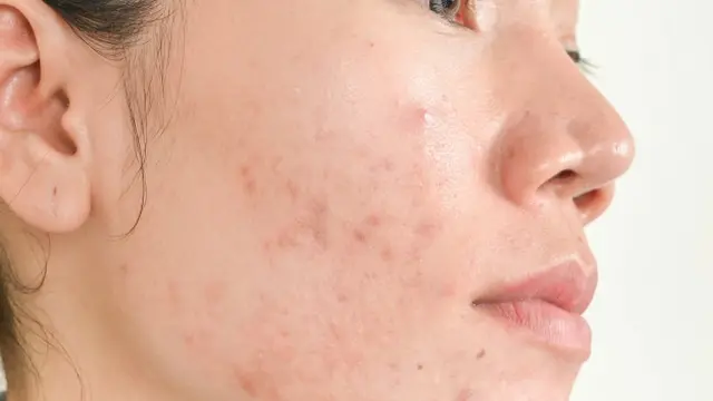 ilustrasi begadang menyebabkan jerawat/freepik