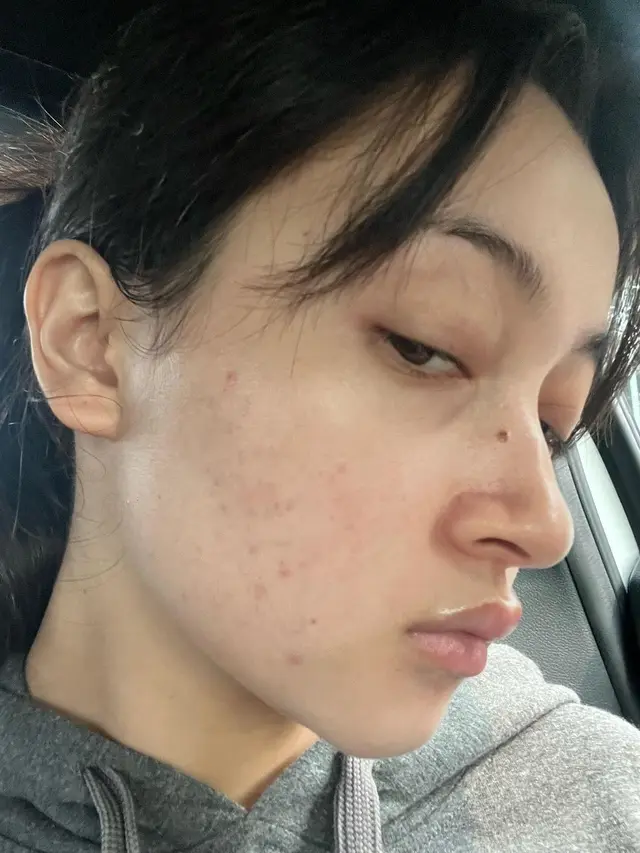 7 Potret Megan Domani Pamer Wajah Berjerawat, Sempat Takut Bertemu Orang Lain