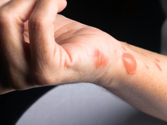 10 Cara Menghilangkan Bekas Luka Melepuh Pakai Bahan Alami Hot Liputan6 Com
