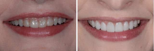 Ilustrasi. Perubahan gigi dengan teknik Veneer./Copyright kcgordondental.com