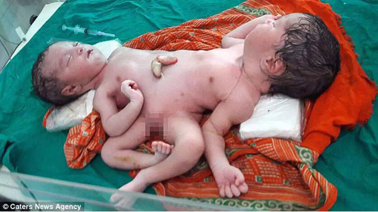 Aneh, Bayi Lahir Kembar Siam Beda Kelamin dalam Satu Tubuh
