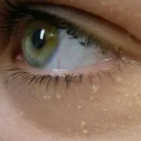 Bintil putih/beautyhealthtips.in