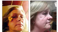 Kim Chilvers usai melakukan biopsi pada jaringan kulit di pipi kanannya (kiri), ternyata benar kanker stadium awal. Kemudian dilakukan pengangkatan (kanan). (Foto:Daily Mail)