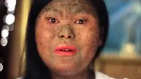 Gara-Gara Kulit Dipenuhi Sisik, Gadis Ini Dijuluki 'Ular'