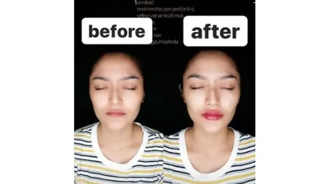 6 Potret Terbaru Siti Badriah Setelah Filler Bibir, Makin Seksi