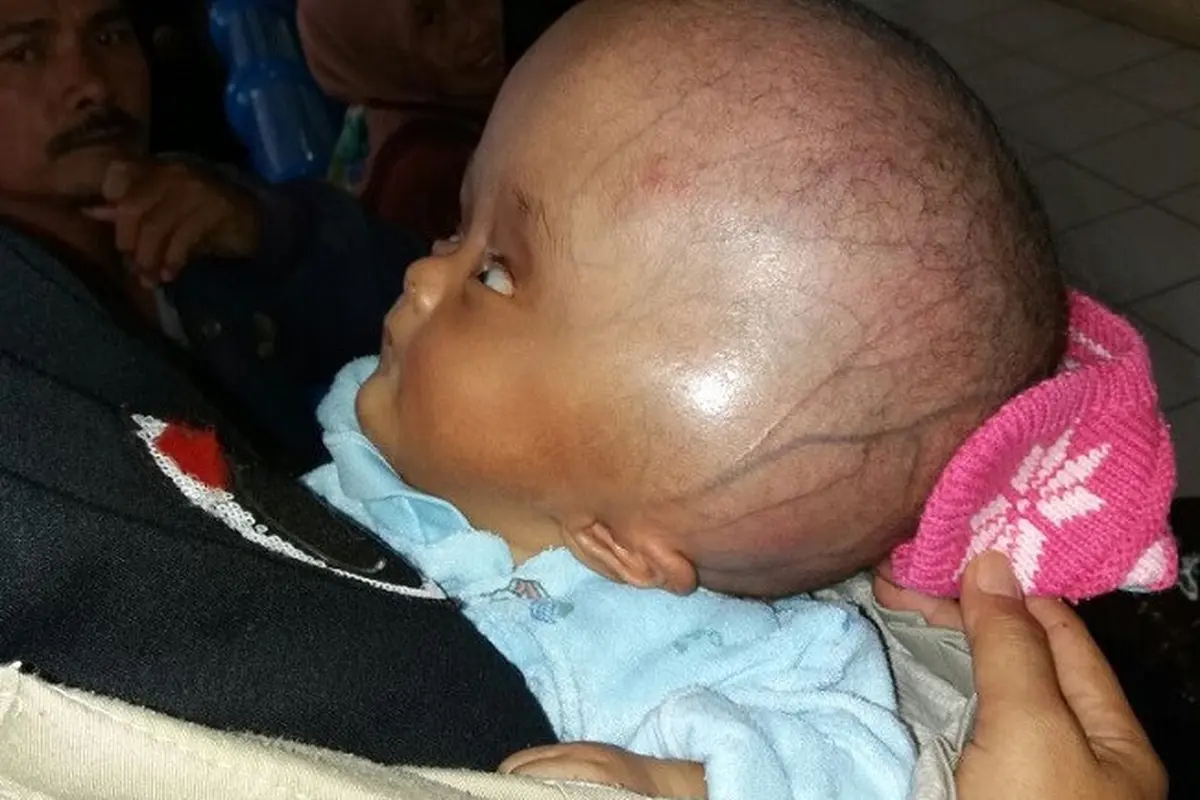 Usaha Hidup Bayi Pengidap Hidrosefalus Usai Ditinggalkan Kembaran