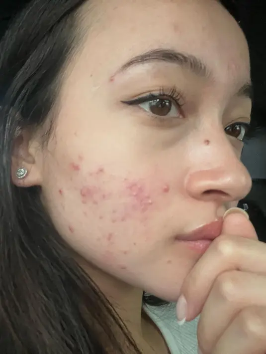 Awalnya Megan tak punya masalah dengan jerawat. Kemudian jerawat mulai bermunculan di wajahnya saat usia 16 tahun. [Instagram @megandomani1410]