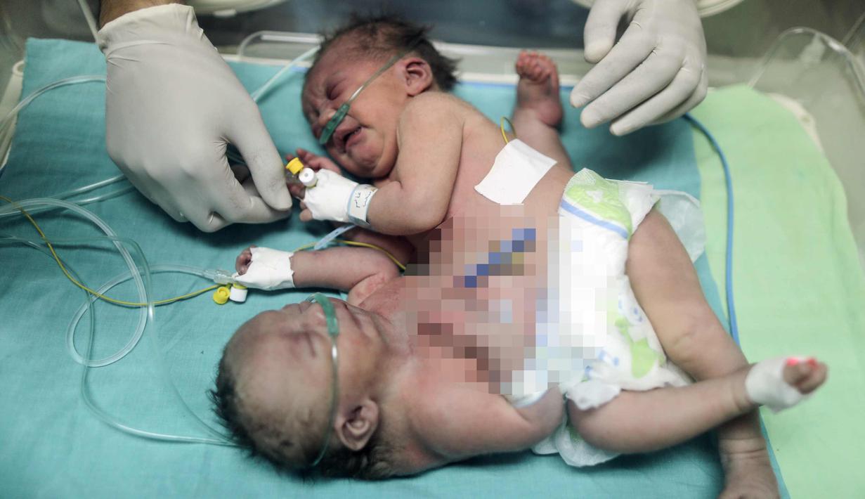 Bayi kembar siam asal Palestina berusia satu hari terlihat di dalam inkubator di Rumah Sakit al-Shifa di Kota Gaza, (22/10). Bayi kembar siam tersebut berjenis kelamin perempuan. (AFP Photo/Mahmud Hams)
