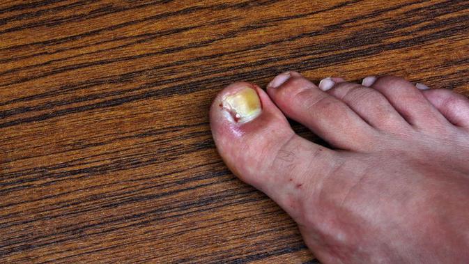 10 Penyebab Cantengan Jempol Kaki dan Cara Tepat Mengobatinya - Vimarsana News