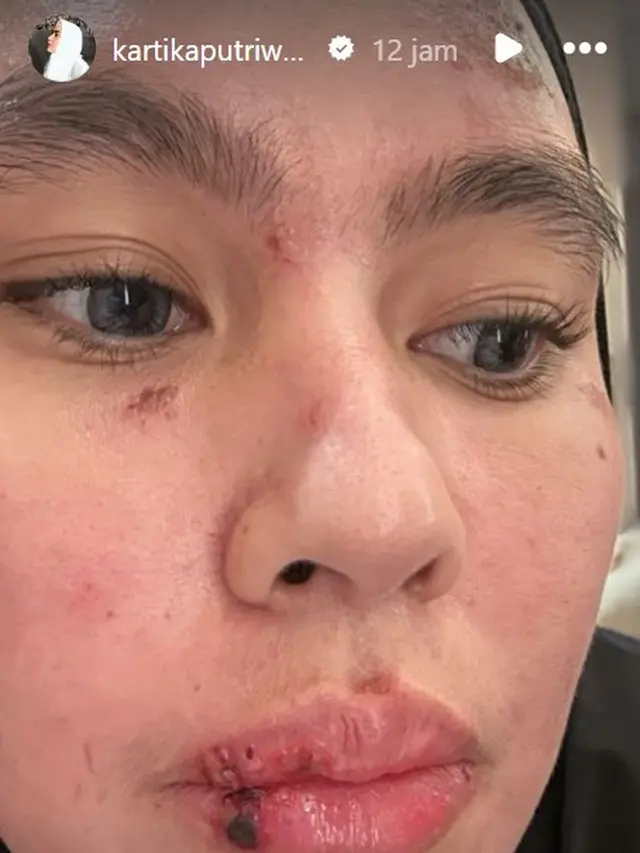 Kartika Putri kena ruam di wajahnya (Instagram/kartikaputriworld)