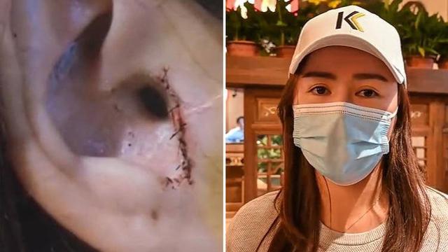 Wanita Ini Syok Saat Tahu Tulang Rawan Di Telinganya Raib Usai Lakukan Operasi Hidung Citizen6 Liputan6 Com