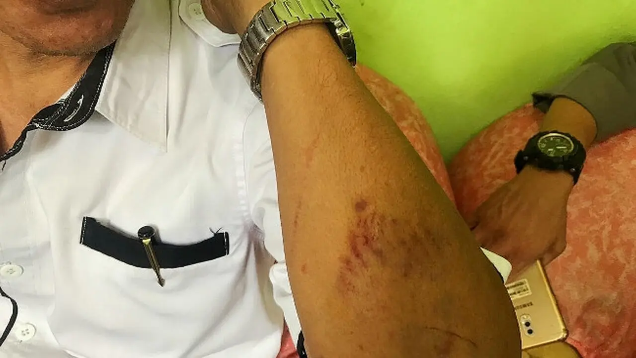 Korban pemukulan oleh siswanya memperlihatkan luka memar di tangan.