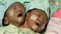 [VIDEO] Kesehatan Bayi Berkepala Dua Asal Cilacap Memburuk