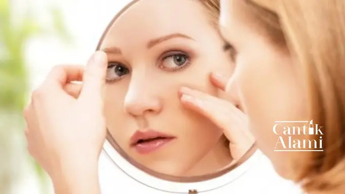 Cantik Alami: Bikin Nggak Pede, Hilangkan Jerawat Batu dengan Cara Mudah